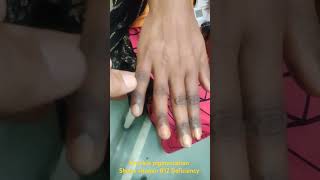 हाथों का कालापन Knuckle pigmentation in vitamin B12 folate deficiency Addison hemochromatosis etc [upl. by Gitel737]