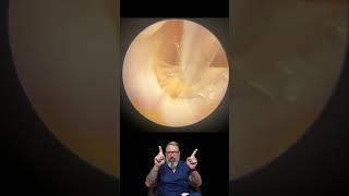 SOFT EAR WAX PLUG amp SKIN REMOVAL  EP973 earcare [upl. by Rori831]