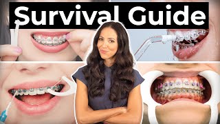 How To Prepare amp What To Expect With BRACES [upl. by Kennith]