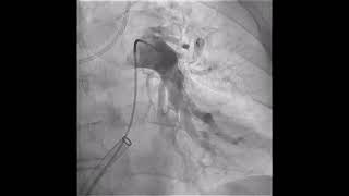 Thrombectomy in Pulmonary embolism [upl. by Aek343]