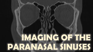 Imaging Anatomy of the Paranasal Sinuses [upl. by Mlohsihc24]