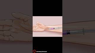 Cortisone Injection for Carpal Tunnel Syndrome [upl. by Mellins]