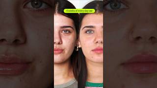 How to Treat Hormonal Acne Before amp After  eyeam 👁️ ❇️ wellness [upl. by Bodnar165]