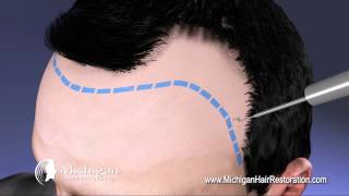 NeoGraft Michigan Hair Restoration 8444HAIRNOW [upl. by Almira]