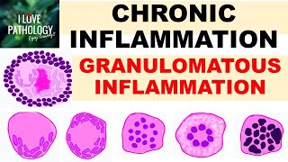 INFLAMMATION Part 9 Chronic Inflammation  GRANULOMATOUS INFLAMMATION [upl. by Madlin]