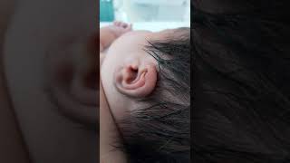 Case 266 neonatal hypertrichosis with infant of diabetic mother congenital hypothyroidism hairy [upl. by Emse]