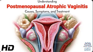 Understanding Vaginal Health After Menopause Atrophic Vaginitis Explained [upl. by Senn310]