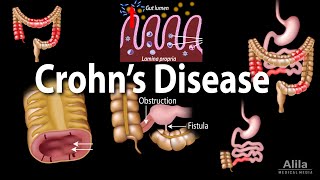 Crohns Disease Pathophysiology Symptoms Risk factors Diagnosis and Treatments Animation [upl. by Ajna]