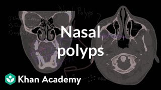 Nasal polyps  Respiratory system diseases  NCLEXRN  Khan Academy [upl. by Namrehs324]