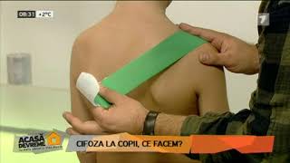 Cifoza la copii Ce facem [upl. by Ajani]