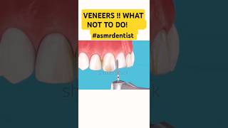 Veneers WHAT NOT TO DO shorts dentist smileasmrdentist [upl. by Nerek]