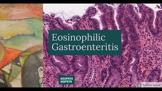 Eosinophilic Gastroenteritis [upl. by Adnal186]