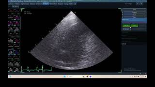 IW 323 AFI LV ECHOPAC ANALYSIS ECHOCARDIOGRAPHY [upl. by Katushka]