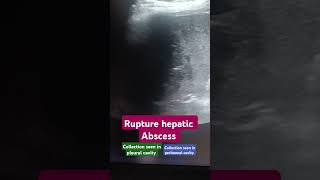 Ruptured Liver abscess usg3d usg hepatic infection radiology emergency phonk halloween [upl. by Donell]