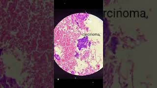 Invasive squamous cell carcinoma [upl. by Blinni]