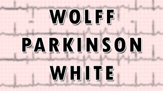 WolffParkinsonWhite Syndrome [upl. by Dumanian]