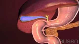 Gallstones Animation [upl. by Teak]