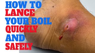 lancing a boil  How To Actually lance a boil  Pop cyst  Infectious skin warts [upl. by Proudfoot236]