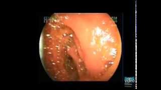 ERCP with BalloonAssisted Enteroscope in Patients with Surgically Altered Upper GI Anatomy [upl. by Oiramad]