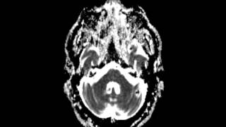 Cavernoma [upl. by Ladnik813]