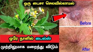 ஒரு பைசா செலவில்லாமல் ஒரே நாளில் பைல்ஸ் முற்றிலுமாக மறைந்து விடும்  Piles Treatment in Tamil Piles [upl. by Shurwood]