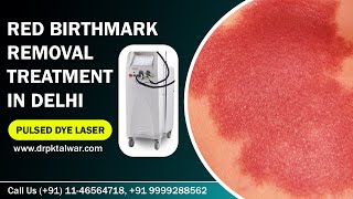 Red Birthmark Removal  Portwine Stain Removal in Delhi India by Pulsed Dye Laser  Dr PK Talwar [upl. by Dougy]