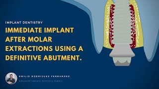 Smith Classification in Immediate Implants after molar extraction [upl. by Kcira473]