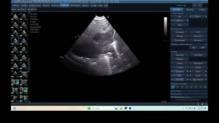 IQ 290 TFAST LUNG MASS ULTRASOUND ICP CPP ECHOPAC ANALYSIS 00 [upl. by Straub]