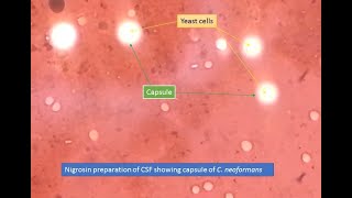 Cryptococcus capsules in Nigrosin preparation [upl. by Garett910]