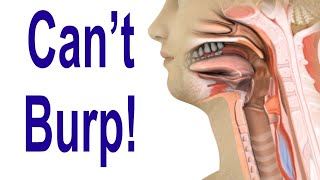 Inability to Burp Retrograde Cricopharyngeus Dysfunction RCPD [upl. by Keiko]