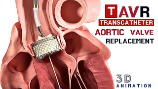 Transcatheter Aortic Valve Replacement TAVR  3D animation cardiology [upl. by Jorgan]