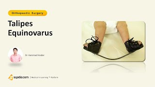 Talipes Equinovarus  Orthopedics Video Lectures  Medical Student  VLearning™ [upl. by Nylitsirk]