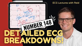 EKG Test Yourself  ECG Case Study 148 [upl. by Karas626]