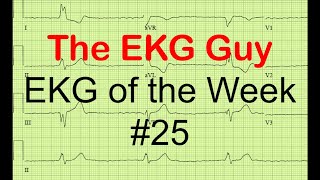 EKGECG of the Week 25  The EKG Guy  wwwekgmd [upl. by Bergstein]