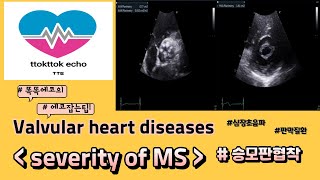 승모판협착 중증도 평가 mitral stenosis severity echocardiography 심장초음파 heart echo view 판막질환 승모판협착 [upl. by Ttayh]