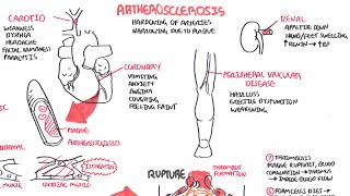 Atherosclerosis  Pathophysiology [upl. by Khano]