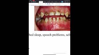 Caries prevention aspects  paediatric dentistry 2 lec 1 [upl. by Sherris192]