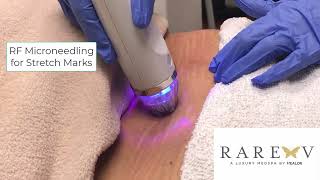 RF microneedling for stretch marks [upl. by Leuname]