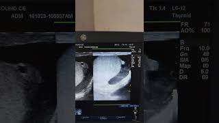 Epididymal cyst with Testicular appendix and Hydrocele Ultrasound [upl. by Nirtak827]