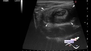 Ecografía abdominal pediátrica invaginación intestinal progresiva gigante en un escolar [upl. by Suilenroc882]