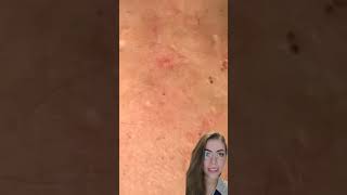 Blackheads Removal  Acne Treatment and Very Satisfying Satisfying Pimple pop blackheads [upl. by Atiuqahs]