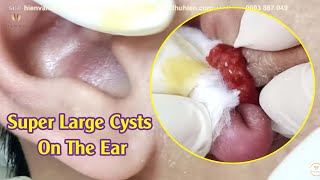 Super Large Cysts On The Ear  Điều trị mụn hiệu quả số 1 TPHCM  Hiền Vân Spa  Minh Hiếu  579 [upl. by Nnael806]