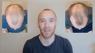 Rosemary Oil for Hair Growth  6 Month Results [upl. by Neruat]