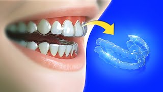 CLEAR ALIGNERS  How Clear Aligners Work  INVISALIGN  Orthodontic Treatment [upl. by Anedal]