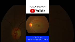 Chloroquine Retinopathy Fundoscopy [upl. by Lesiram]