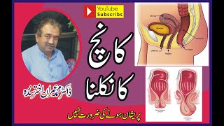 prolapse of rectum lecture by dr imran sadrah urdu  hindi [upl. by Jaquelin877]