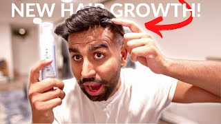 How To Use a Derma Roller and Minoxidil For Hair Growth [upl. by Hengel]