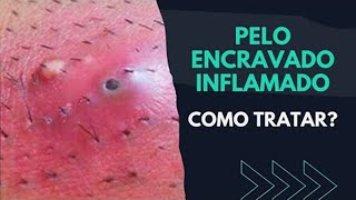 PELO ENCRAVADO INFLAMADO COMO TRATAR  SAIBA [upl. by Eddy]