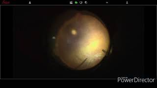 Luxated IOL rescue with sutureless scleral fixation IOL [upl. by Tiras]