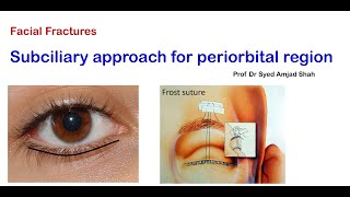 Subciliary approach for Periorbital region  English  Oral Maxillofacial Surgery  Syed Amjad Shah [upl. by Laeno142]